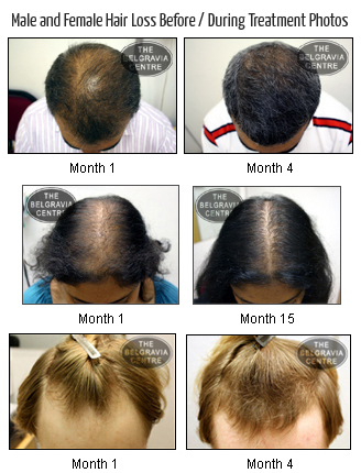 propecia regrow frontal hair